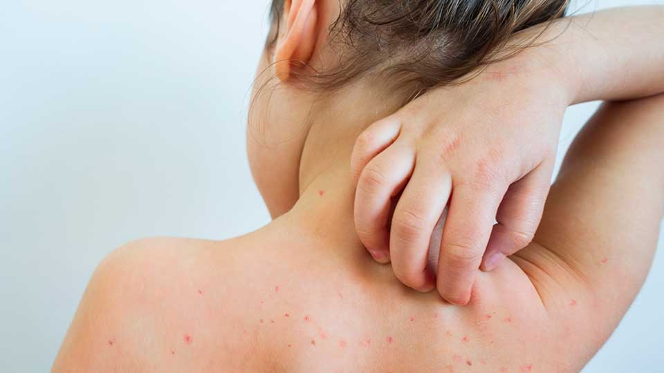 Child with Measles