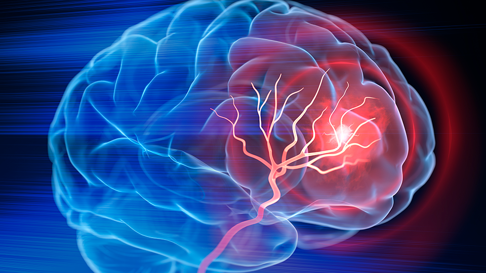 X- Ray illustration of brain stroke