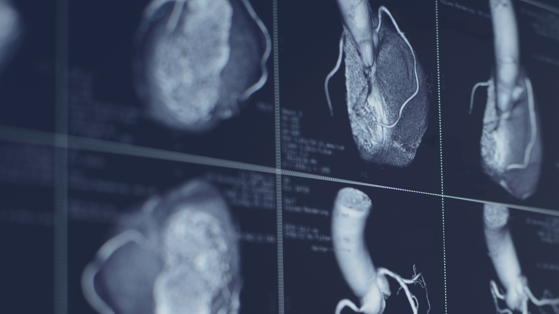 Learn how a $50 Heart Scan could save your life.