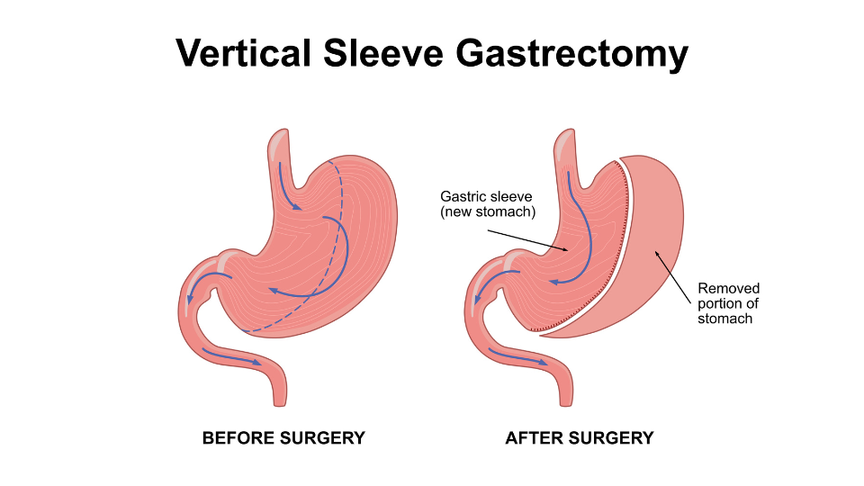 Illustration of a vertical sleeve gastrectomy
