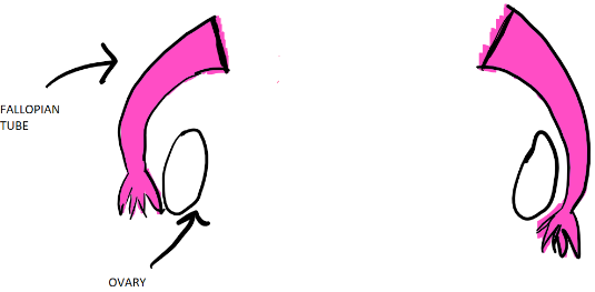 total-hysterectomy
